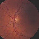 Autoimmune Retinopathy