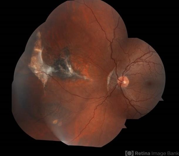Retinitis Sclopetaria