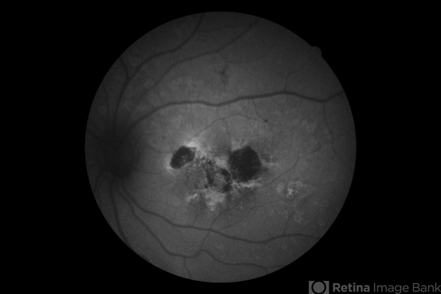 Butterfly-Shaped Pattern Dystrophy