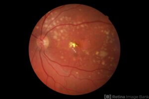 Pattern Dystrphy Oct Butterfly-Shaped Pattern Dystrophy: Clinical Features, Genetics, and ...