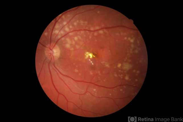 Butterfly-Shaped Pattern Dystrophy