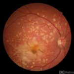 Butterfly-Shaped Pattern Dystrophy