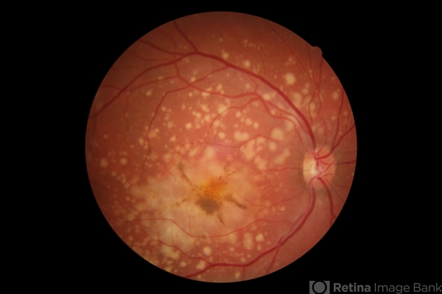Butterfly-Shaped Pattern Dystrophy: Clinical Features, Genetics, and Findings