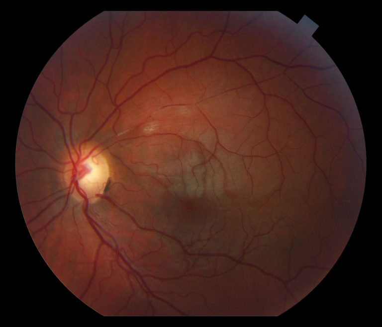 Susac Syndrome
