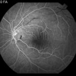 Susac Syndrome