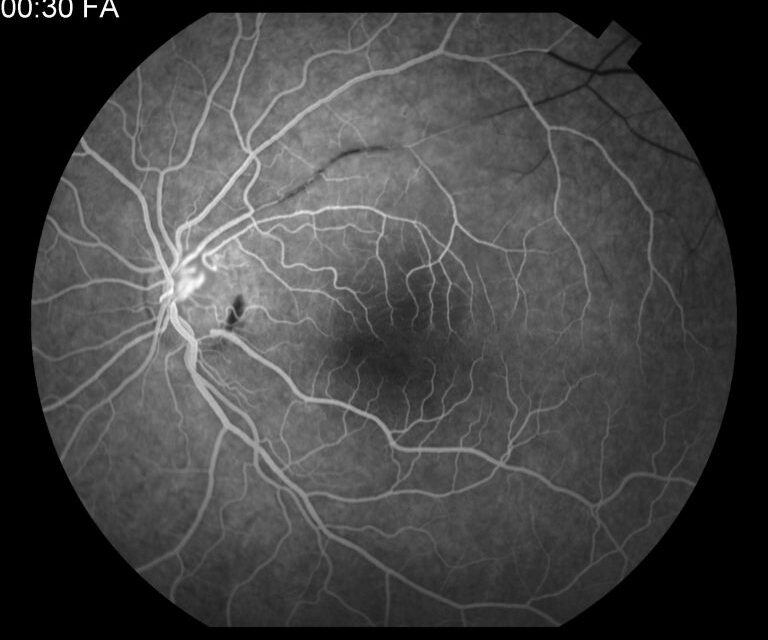 Susac Syndrome (Retinal Artery Involvement)