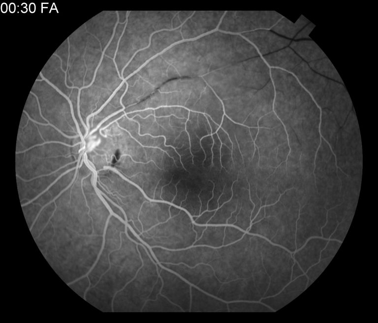 Susac Syndrome