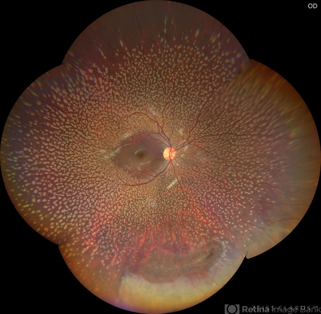 Benign Familial Fleck Retina