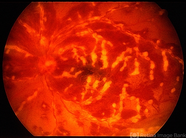 Frosted Branch Angiitis