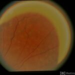 Fundus Albipunctatus