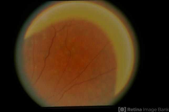 Fundus Albipunctatus