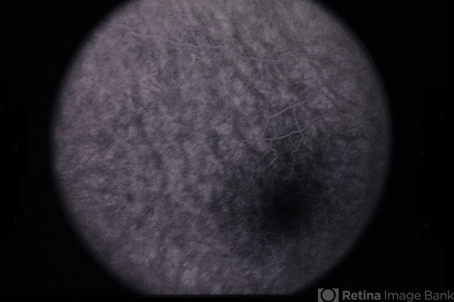 Fundus Albipunctatus