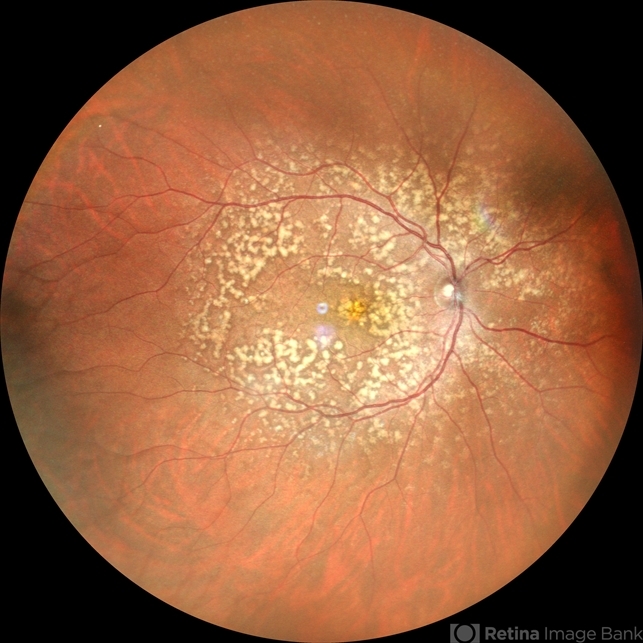 Benign Familial Fleck Retina