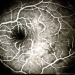 Frosted Branch Angiitis