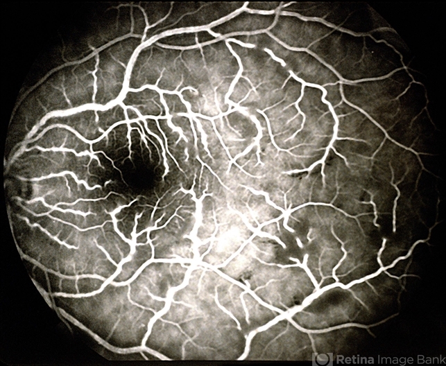 Frosted Branch Angiitis: Clinical Features, Causes, and Management