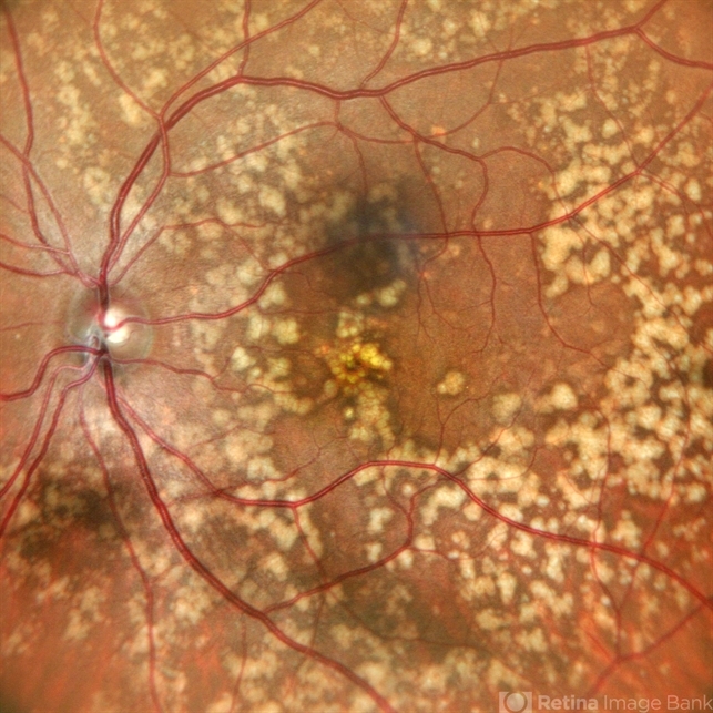 Benign Familial Fleck Retina