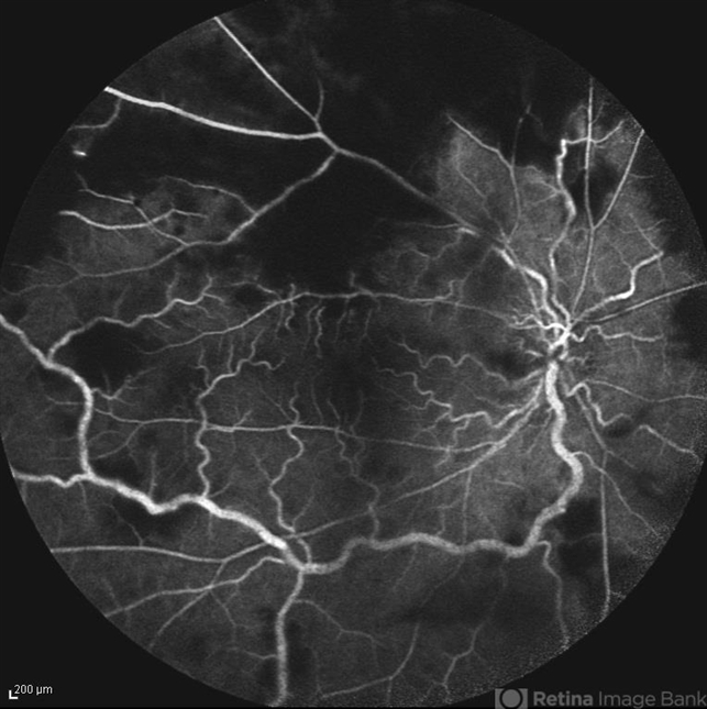 Frosted Branch Angiitis