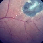 Kyrieleis Arteriolitis