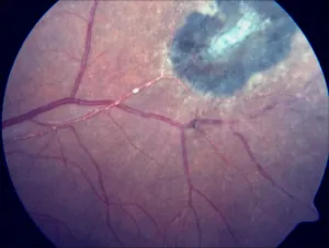 Kyrieleis Arteriolitis: All revealed
