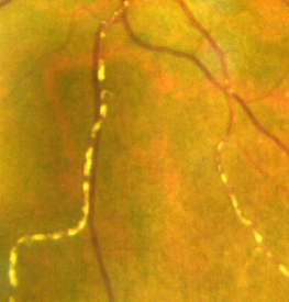 Kyrieleis Arteriolitis