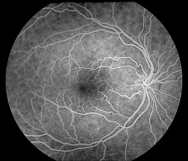 Idiopathic Retinal Vasospasm