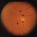 Idiopathic Retinal Vasospasm