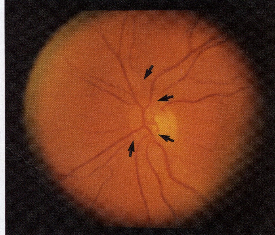 Idiopathic Retinal Vasospasm