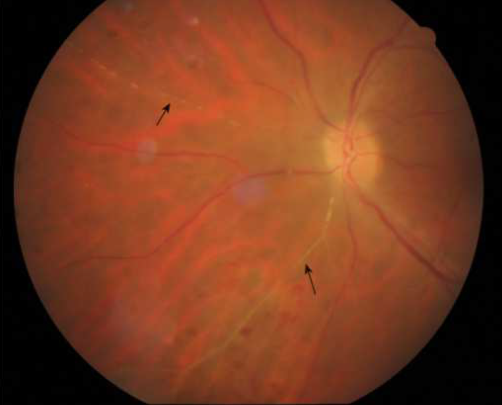 Kyrieleis Arteriolitis