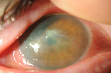 Fungal vs Bacterial Keratitis