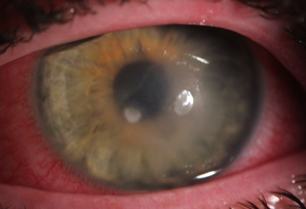keratitis