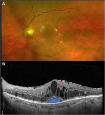 Resistant Diabetic Macular Edema