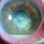 Fungal vs Bacterial Keratitis