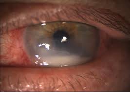 Fungal vs Bacterial Keratitis