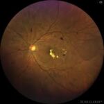 Resistant Diabetic Macular Edema