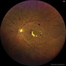 Role of Steroids in Resistant Diabetic Macular Edema