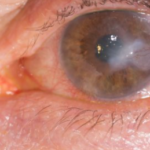 keratitis