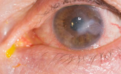 Why Some Keratitis Cases Fail Treatment: Hidden Clinical Pitfalls