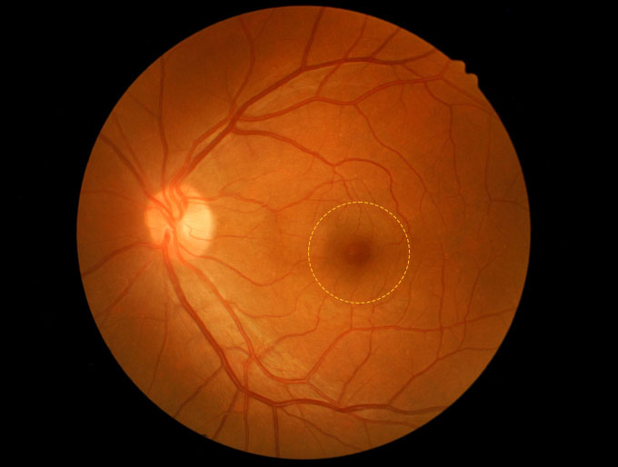 Macular Hole