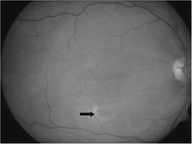 Iatrogenic Macular