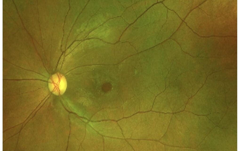 Why Some Macular Holes Reopen After Successful Surgery