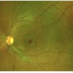 Macular Hole
