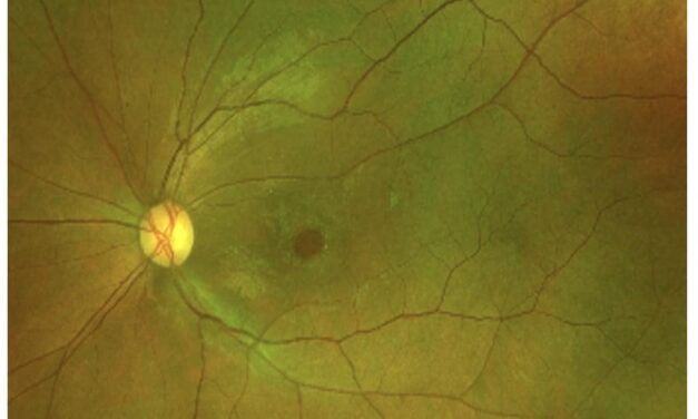 Why Some Macular Holes Reopen After Successful Surgery