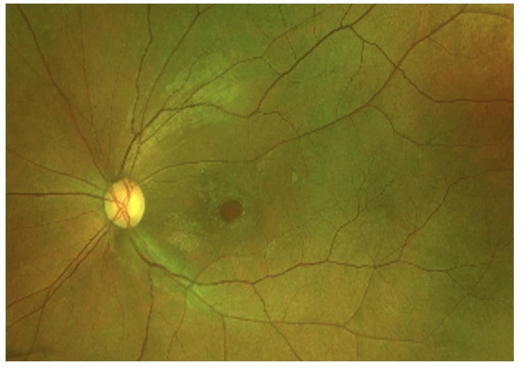Macular Hole