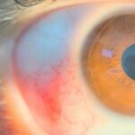 trematode-associated uveitis