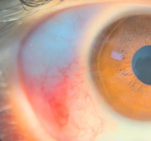Trematode-Associated Uveitis: An Underrecognized Entity