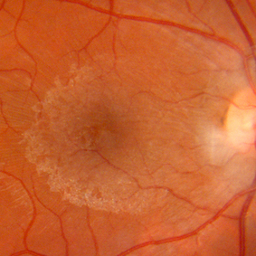 Epiretinal Membrane
