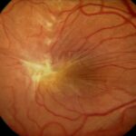Epiretinal Membrane