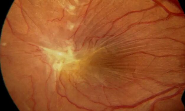 Epiretinal Membrane Recurrence: Risk Factors and Prevention