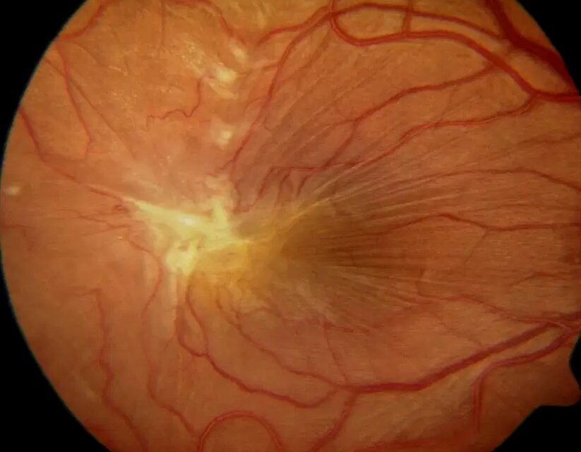Epiretinal Membrane Recurrence: Risk Factors and Prevention