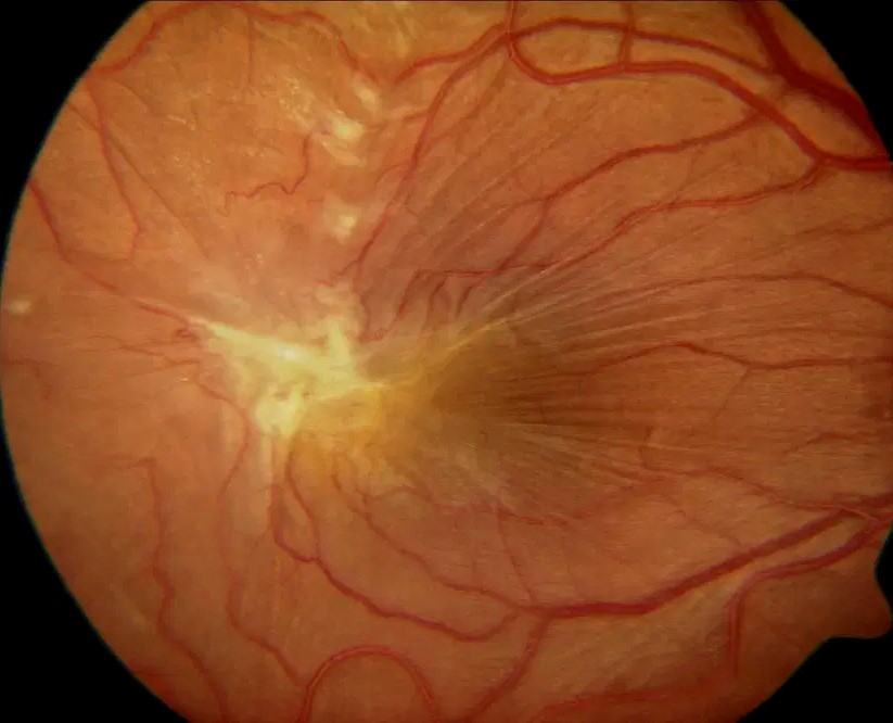 Epiretinal Membrane